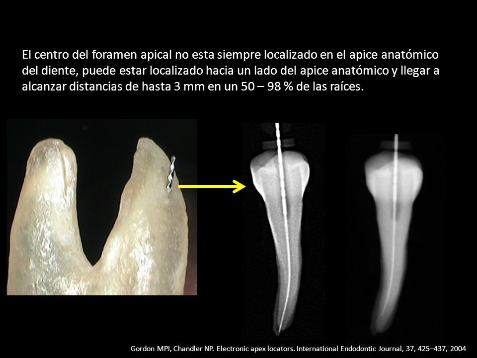 El centro del foramen apical no esta siempre localizado en el apice anatómico del diente, puede estar localizado hacia un lado del apice anatómico y llegar a alcanzar distancias de hasta 3 mm en un 50 – 98 % de las raíces.