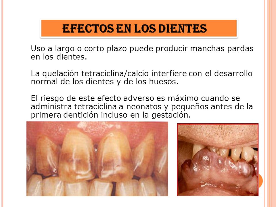 Efectos en los dientes Uso a largo o corto plazo puede producir manchas pardas en los dientes.
