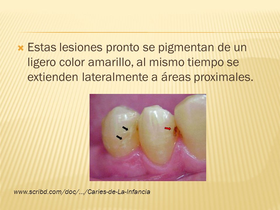 Estas lesiones pronto se pigmentan de un ligero color amarillo, al mismo tiempo se extienden lateralmente a áreas proximales.
