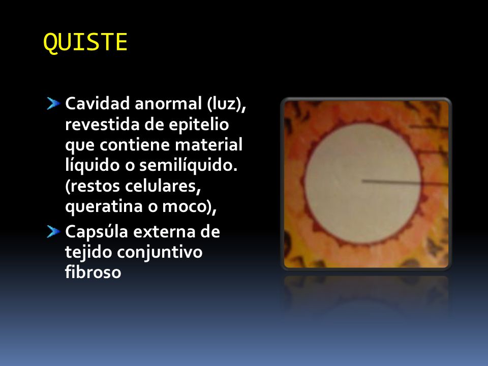 QUISTE Cavidad anormal (luz), revestida de epitelio que contiene material líquido o semilíquido. (restos celulares, queratina o moco),