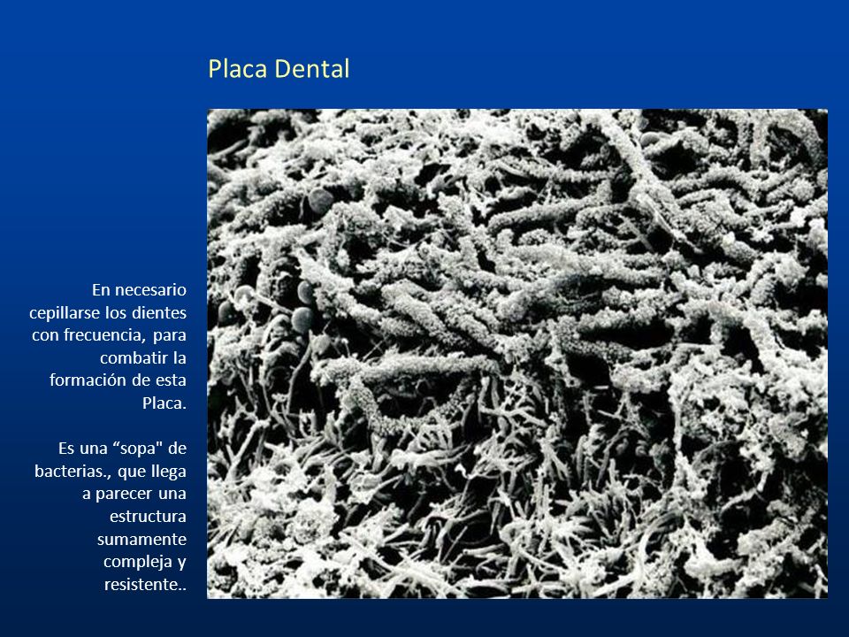 Placa Dental En necesario cepillarse los dientes con frecuencia, para combatir la formación de esta.