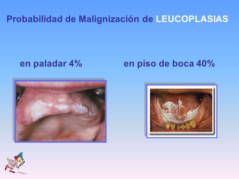 Probabilidad de Malignización de LEUCOPLASIAS en paladar 4% en piso de boca 40%