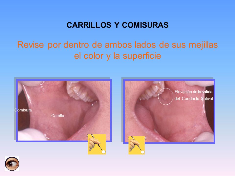 CARRILLOS Y COMISURAS Revise por dentro de ambos lados de sus mejillas el color y la superficie