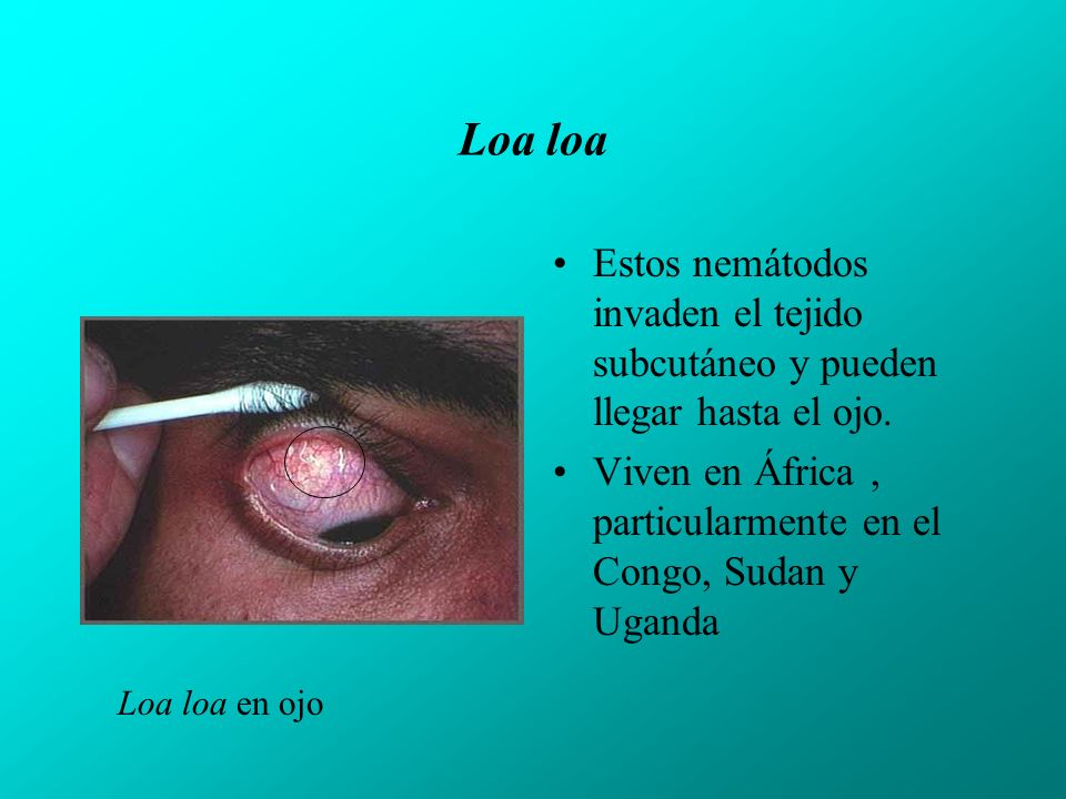 Loa loa Estos nemátodos invaden el tejido subcutáneo y pueden llegar hasta el ojo. Viven en África , particularmente en el Congo, Sudan y Uganda.
