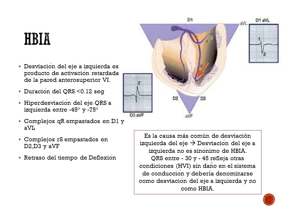 HBIA Desviación del eje a izquierda es producto de activación retardada de la pared anterosuperior VI.