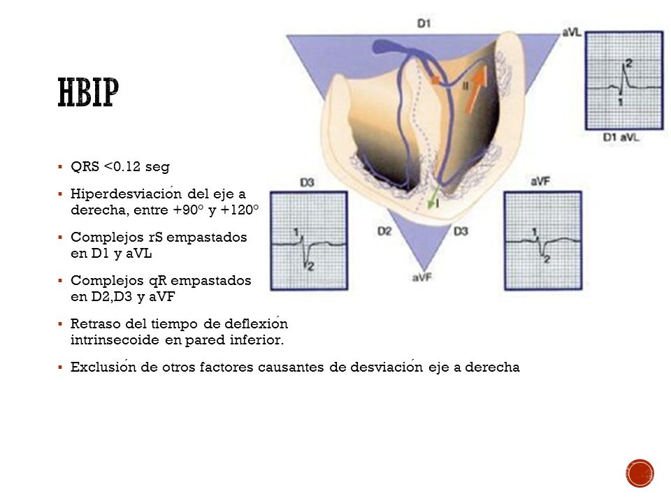 HBIP QRS <0.12 seg. Hiperdesviación del eje a derecha, entre +90° y +120° Complejos rS empastados en D1 y aVL.