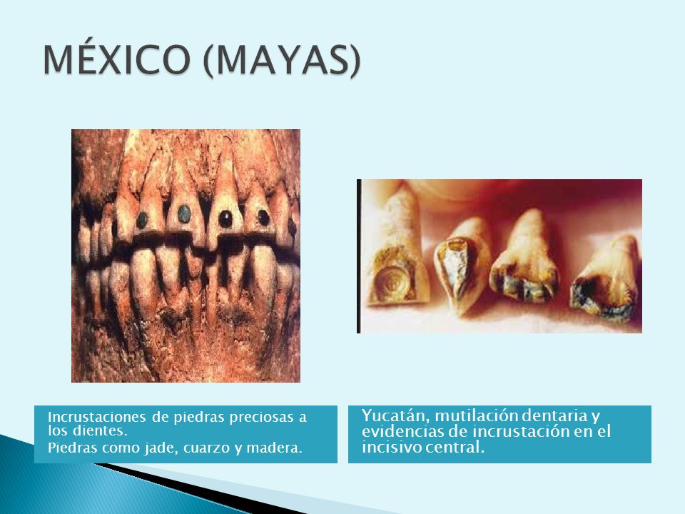 MÉXICO (MAYAS) Incrustaciones de piedras preciosas a los dientes. Piedras como jade, cuarzo y madera.
