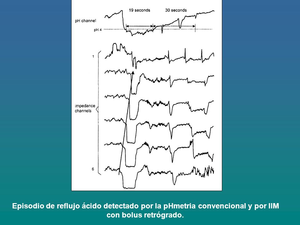 Episodio de reflujo ácido detectado por la pHmetria convencional y por IIM