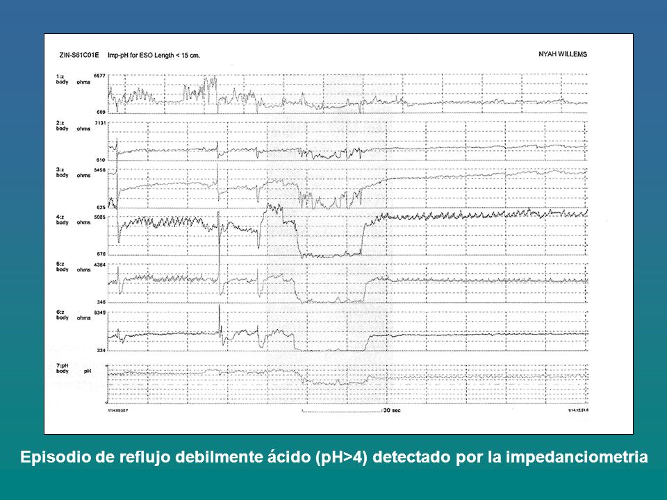 Episodio de reflujo debilmente ácido (pH>4) detectado por la impedanciometria