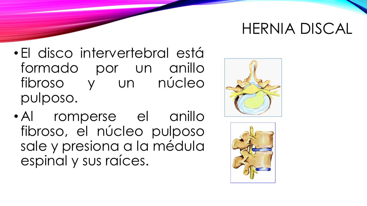 Hernia discal El disco intervertebral está formado por un anillo fibroso y un núcleo pulposo.