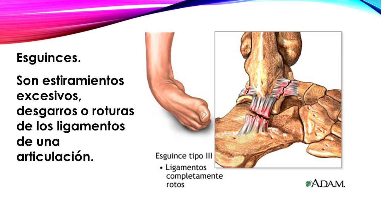 Esguinces. Son estiramientos excesivos, desgarros o roturas de los ligamentos de una articulación.