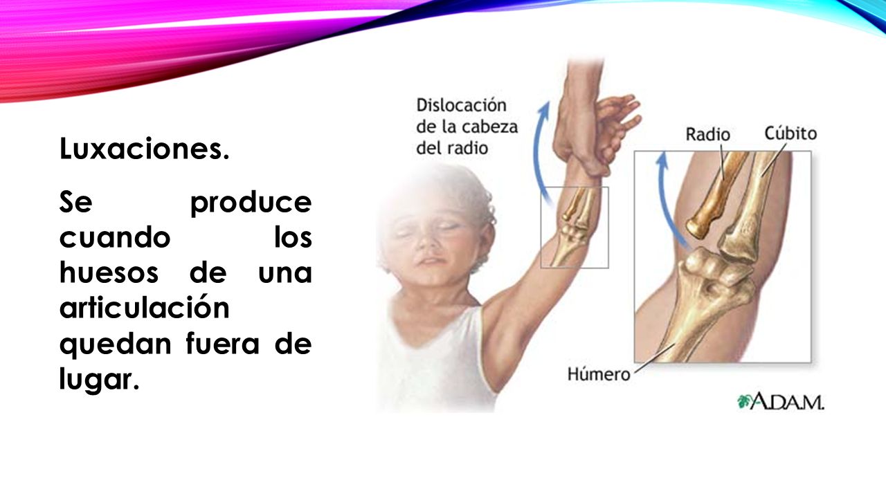 Luxaciones. Se produce cuando los huesos de una articulación quedan fuera de lugar.