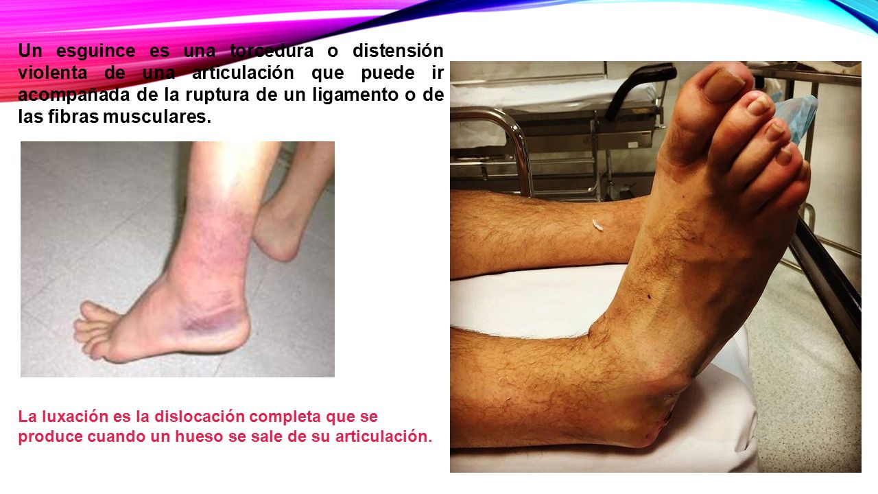 Un esguince es una torcedura o distensión violenta de una articulación que puede ir acompañada de la ruptura de un ligamento o de las fibras musculares.