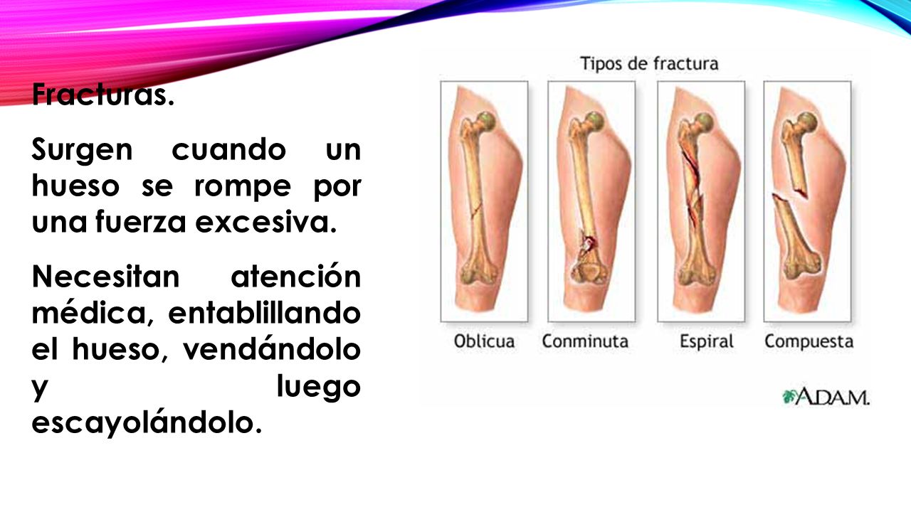 Fracturas. Surgen cuando un hueso se rompe por una fuerza excesiva.