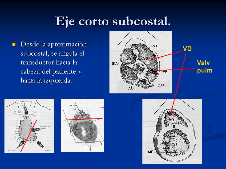 Eje corto subcostal. Desde la aproximación subcostal, se angula el transductor hacia la cabeza del paciente y hacia la izquierda.