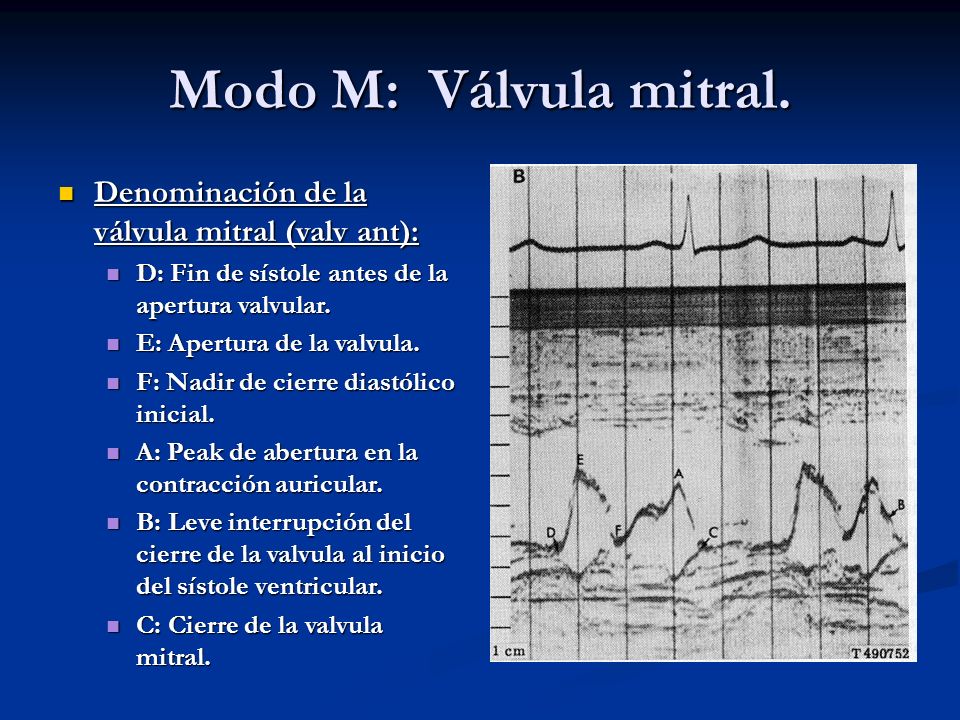 Modo M: Válvula mitral. Denominación de la válvula mitral (valv ant):