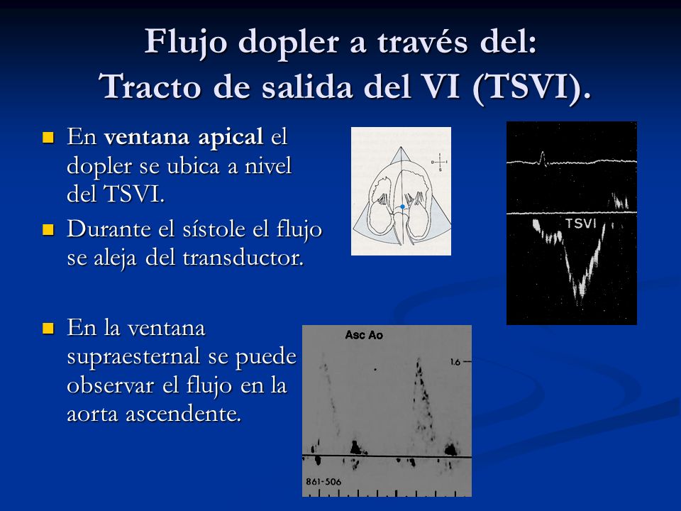 Flujo dopler a través del: Tracto de salida del VI (TSVI).
