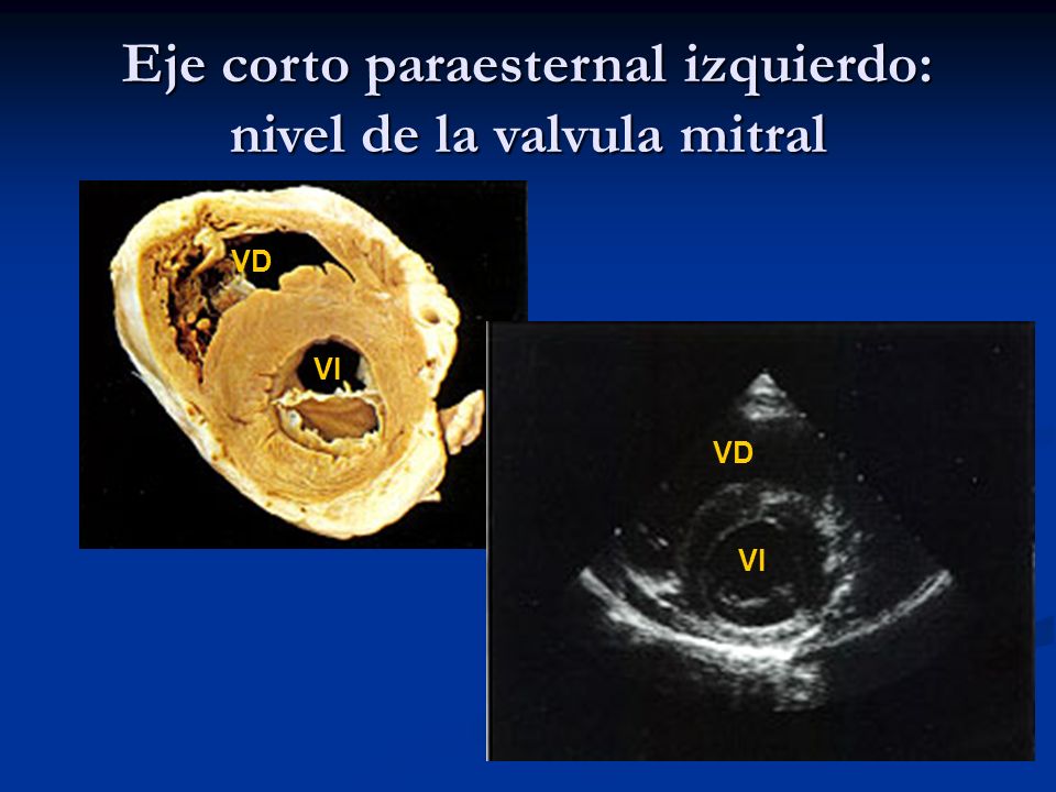 Eje corto paraesternal izquierdo: nivel de la valvula mitral