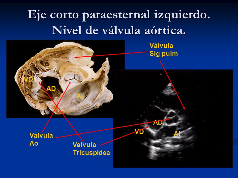 Eje corto paraesternal izquierdo. Nivel de válvula aórtica.