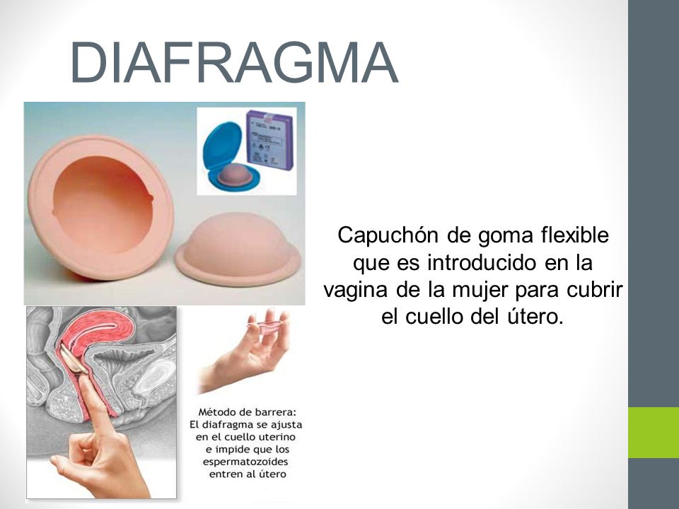 DIAFRAGMA Capuchón de goma flexible que es introducido en la vagina de la mujer para cubrir el cuello del útero.