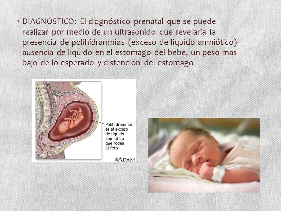 DIAGNÓSTICO: El diagnóstico prenatal que se puede realizar por medio de un ultrasonido que revelaría la presencia de polihidramnias (exceso de liquido amniótico) ausencia de liquido en el estomago del bebe, un peso mas bajo de lo esperado y distención del estomago