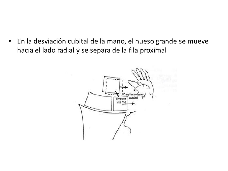 En la desviación cubital de la mano, el hueso grande se mueve hacia el lado radial y se separa de la fila proximal