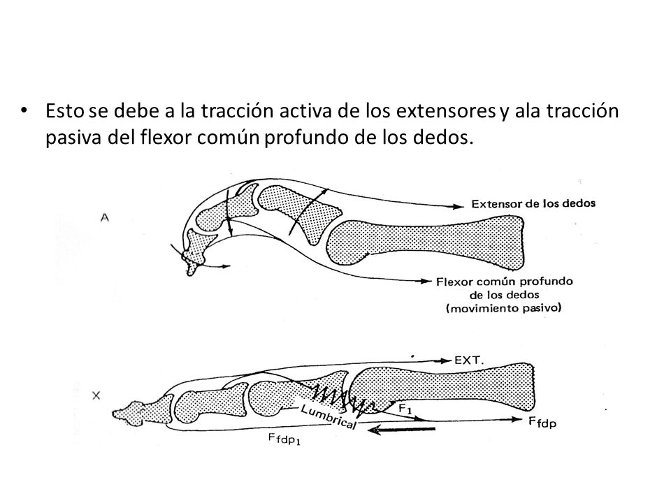 Esto se debe a la tracción activa de los extensores y ala tracción pasiva del flexor común profundo de los dedos.