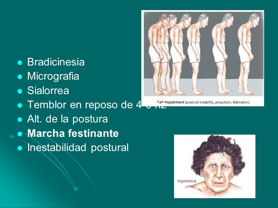Bradicinesia Micrografia. Sialorrea. Temblor en reposo de 4-6 hz. Alt. de la postura. Marcha festinante.