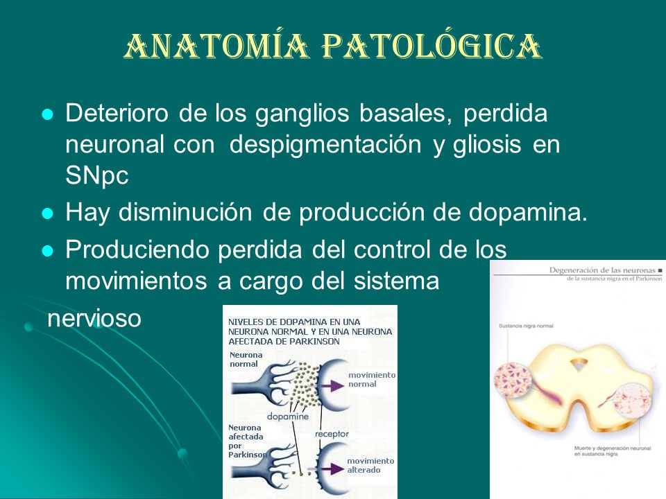 Anatomía Patológica Deterioro de los ganglios basales, perdida neuronal con despigmentación y gliosis en SNpc.