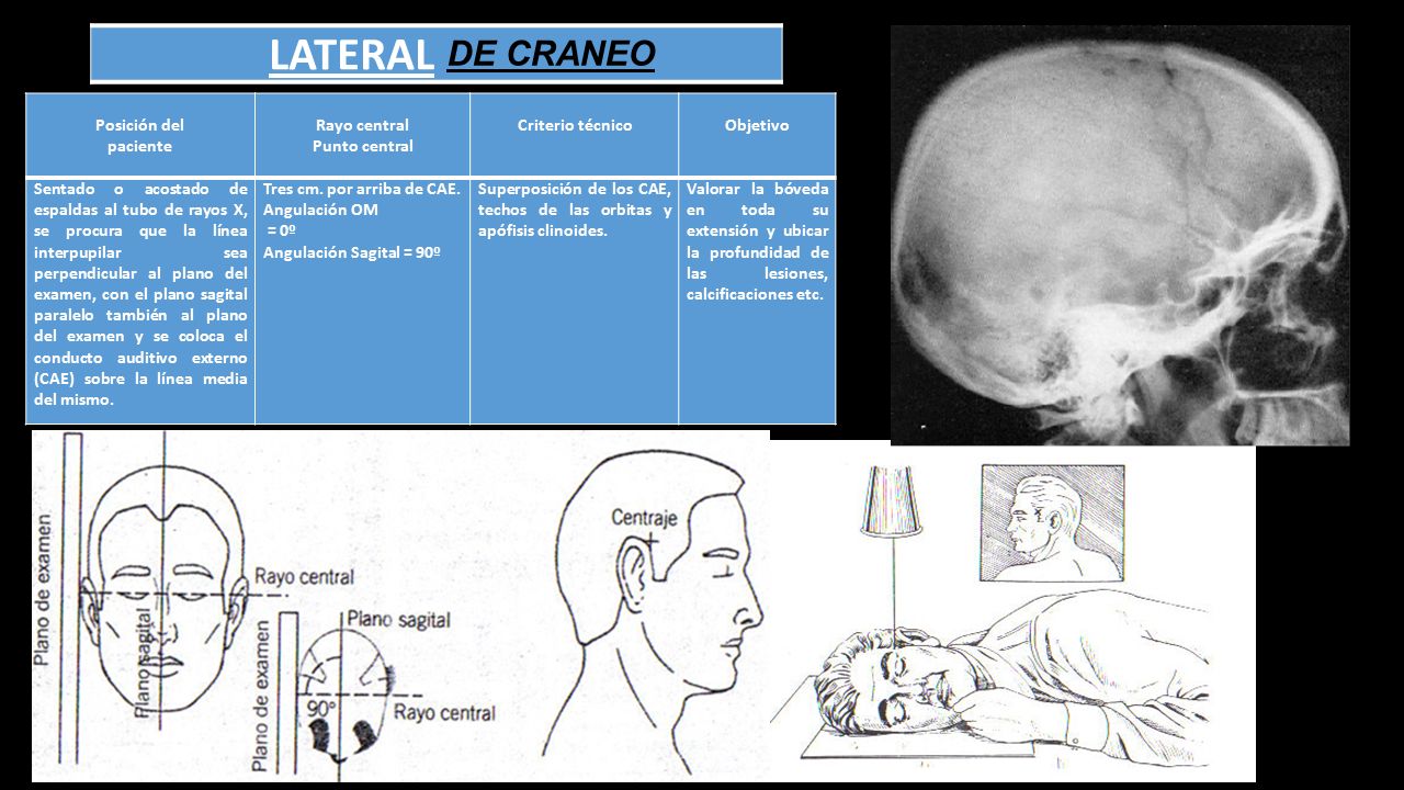 LATERAL DE CRANEO Posición del paciente Rayo central Punto central