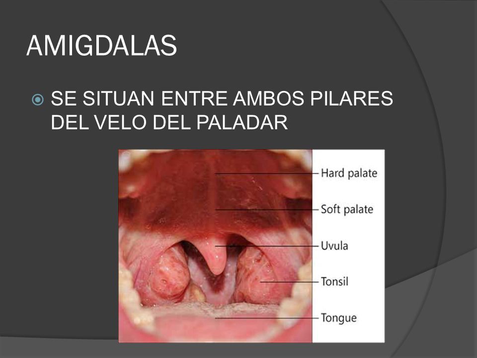 AMIGDALAS SE SITUAN ENTRE AMBOS PILARES DEL VELO DEL PALADAR