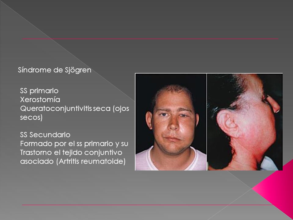 Síndrome de Sjögren SS primario. Xerostomía. Queratoconjuntivitis seca (ojos secos) SS Secundario.