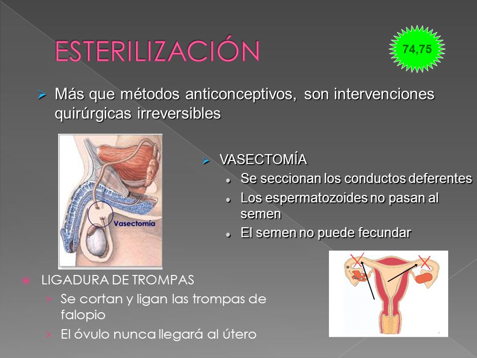 ESTERILIZACIÓN 74,75. Más que métodos anticonceptivos, son intervenciones quirúrgicas irreversibles.