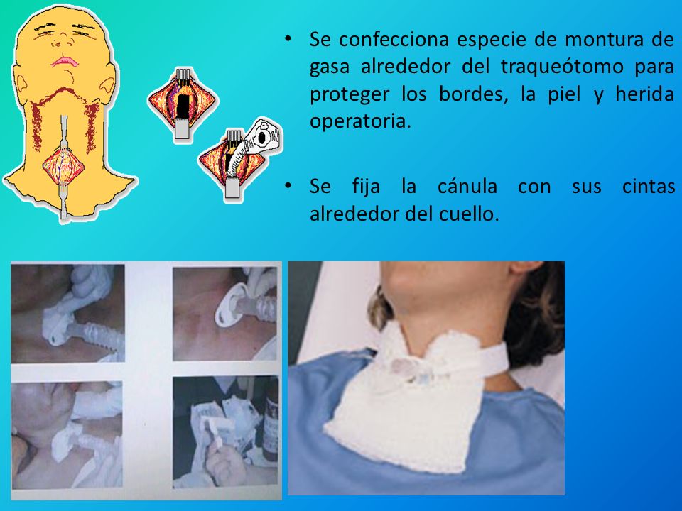 Se confecciona especie de montura de gasa alrededor del traqueótomo para proteger los bordes, la piel y herida operatoria.