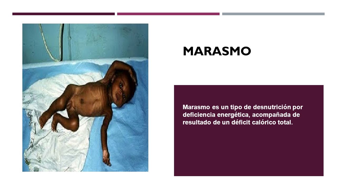 MARASMO Marasmo es un tipo de desnutrición por deficiencia energética, acompañada de resultado de un déficit calórico total.