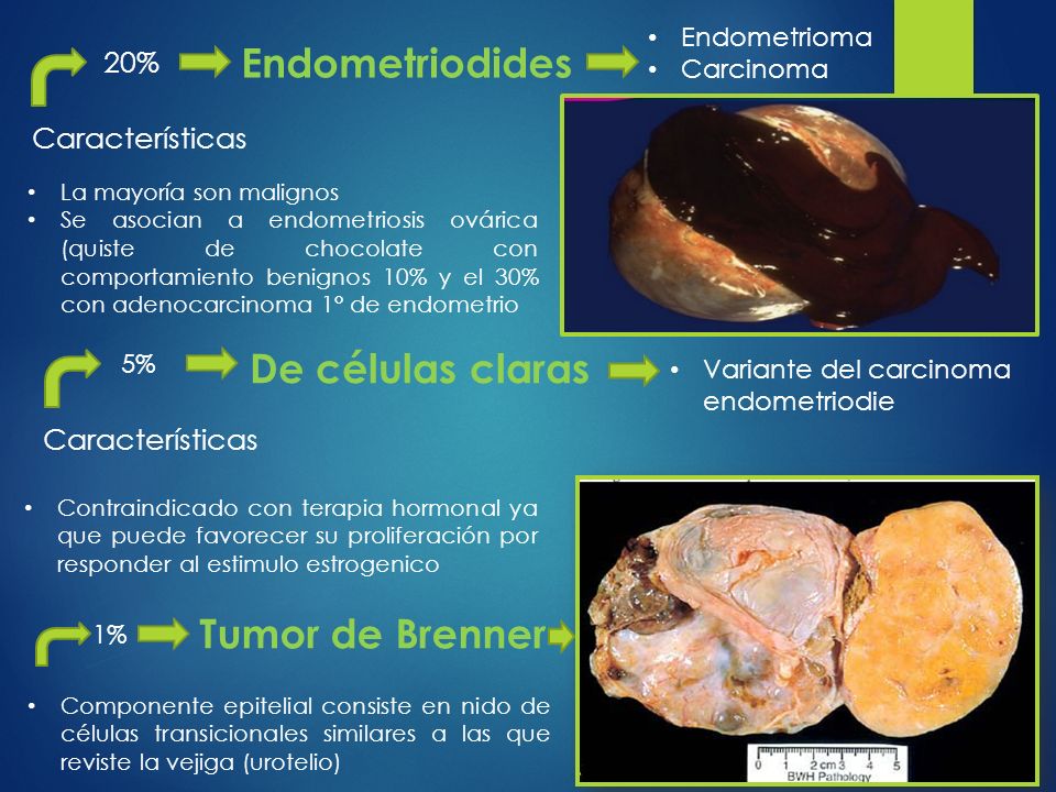 Endometriodides De células claras Tumor de Brenner 20% Características