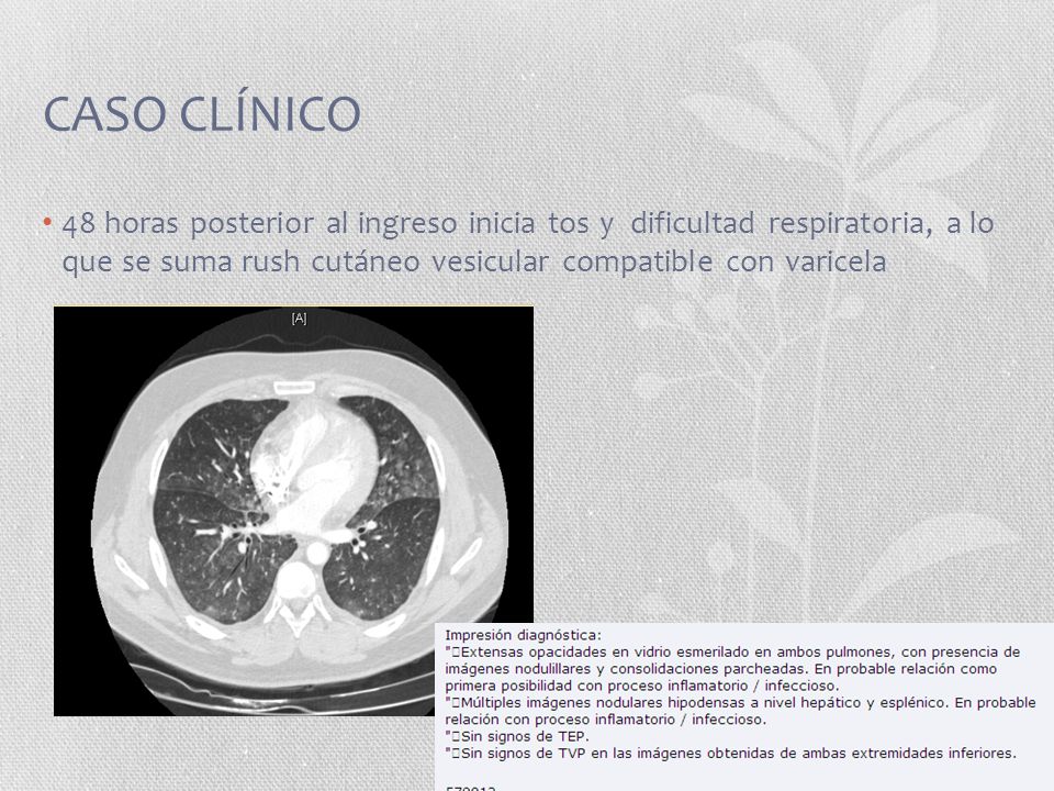 CASO CLÍNICO 48 horas posterior al ingreso inicia tos y dificultad respiratoria, a lo que se suma rush cutáneo vesicular compatible con varicela.