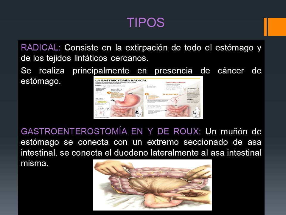 TIPOS RADICAL: Consiste en la extirpación de todo el estómago y de los tejidos linfáticos cercanos.