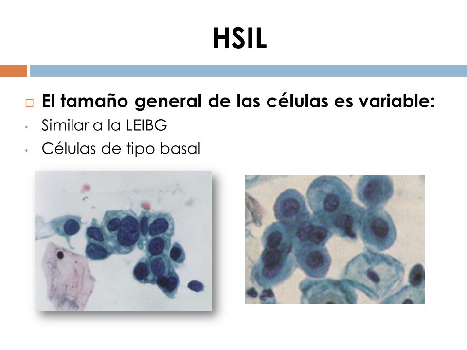 HSIL El tamaño general de las células es variable: Similar a la LEIBG