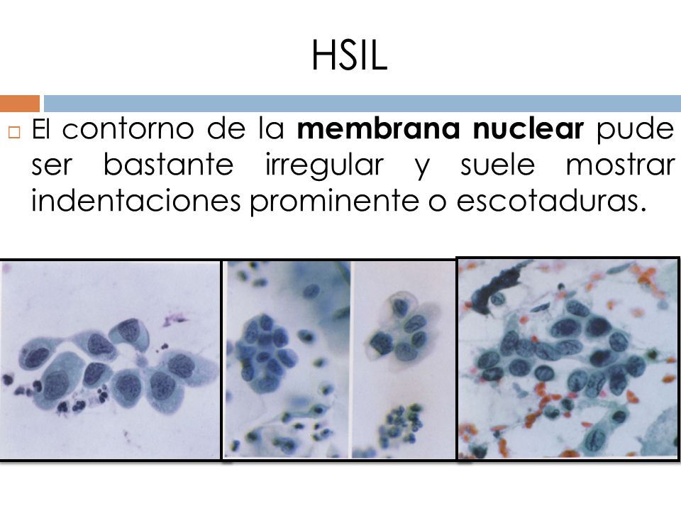 HSIL El contorno de la membrana nuclear pude ser bastante irregular y suele mostrar indentaciones prominente o escotaduras.