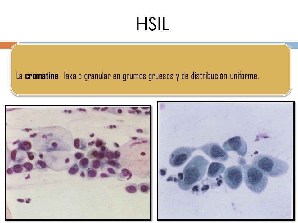HSIL La cromatina laxa o granular en grumos gruesos y de distribución uniforme.
