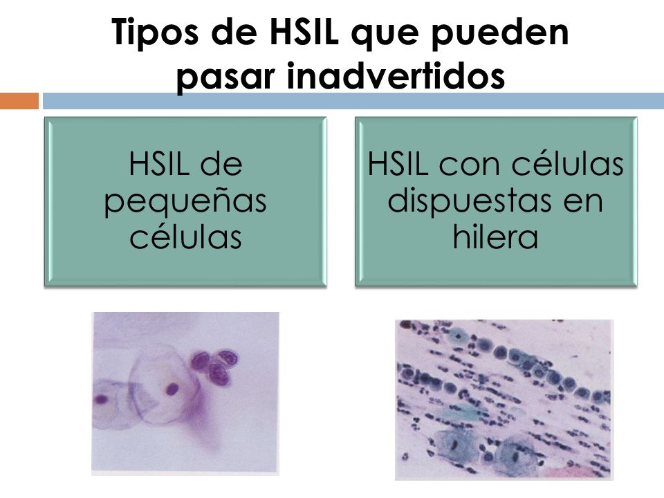 Tipos de HSIL que pueden pasar inadvertidos