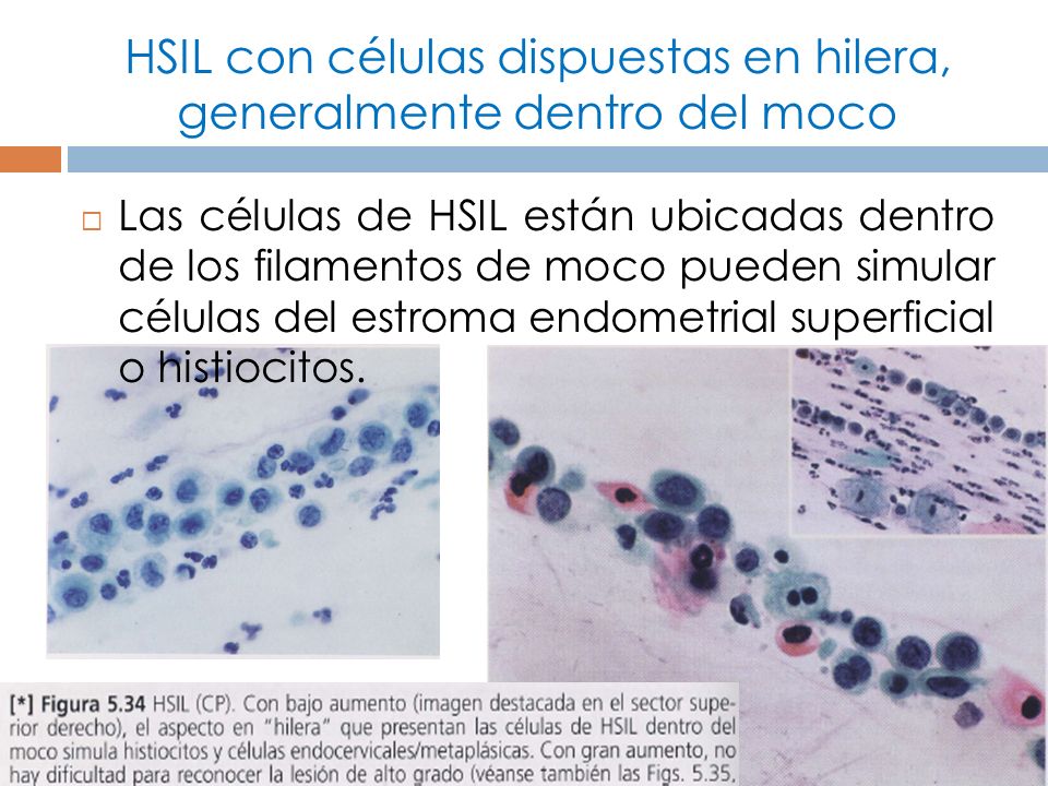 HSIL con células dispuestas en hilera, generalmente dentro del moco