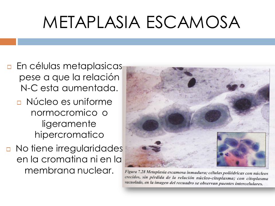 METAPLASIA ESCAMOSA En células metaplasicas pese a que la relación N-C esta aumentada.