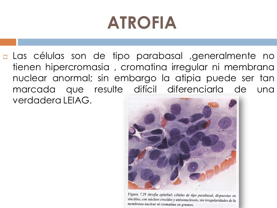 ATROFIA