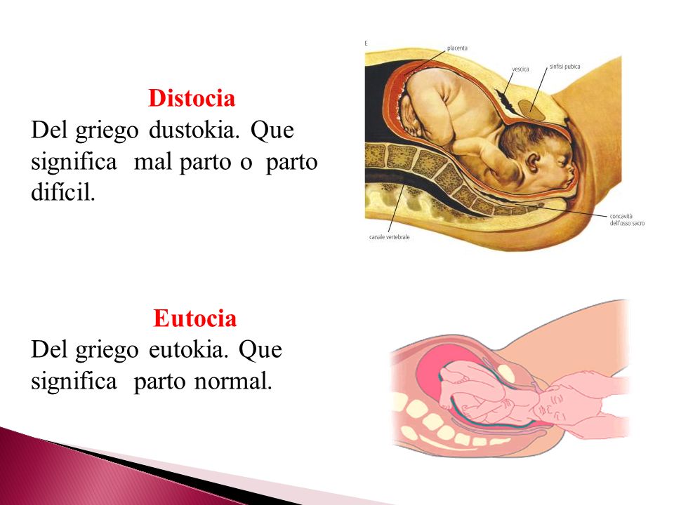 Distocia Del griego dustokia. Que significa mal parto o parto difícil.