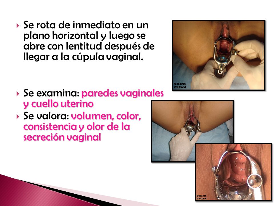 Se rota de inmediato en un plano horizontal y luego se abre con lentitud después de llegar a la cúpula vaginal.