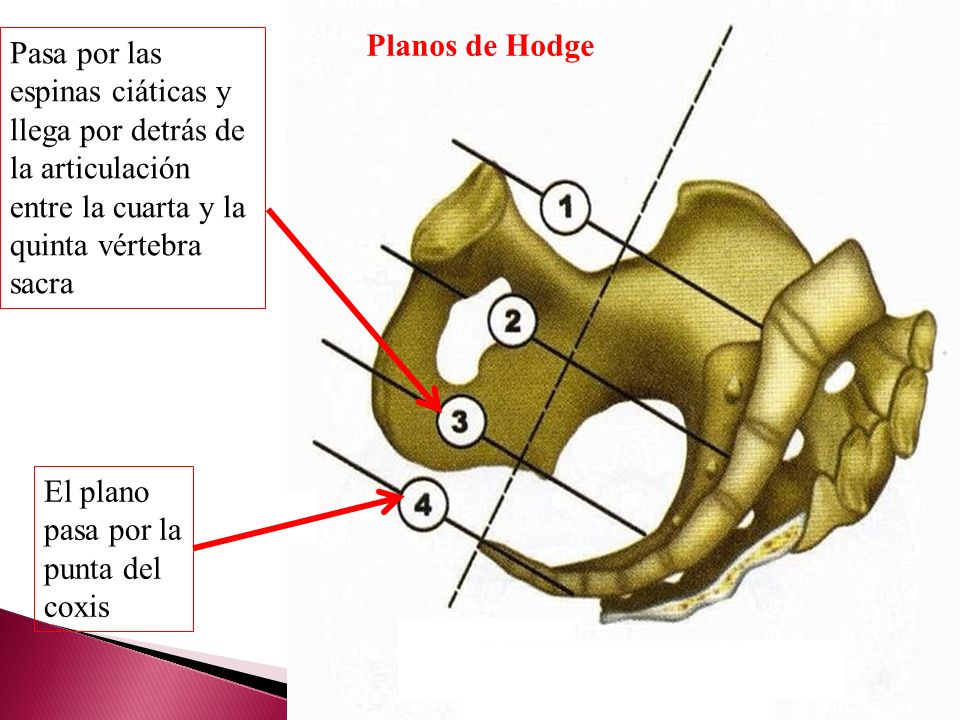Planos de Hodge Pasa por las espinas ciáticas y llega por detrás de la articulación entre la cuarta y la quinta vértebra sacra.