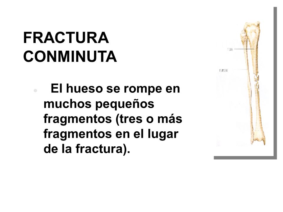 FRACTURA CONMINUTA El hueso se rompe en muchos pequeños fragmentos (tres o más fragmentos en el lugar de la fractura).
