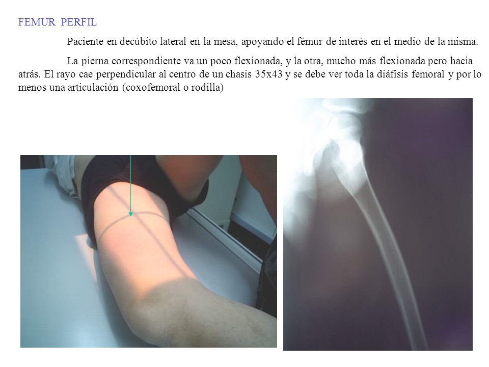 FEMUR PERFIL Paciente en decúbito lateral en la mesa, apoyando el fémur de interés en el medio de la misma.